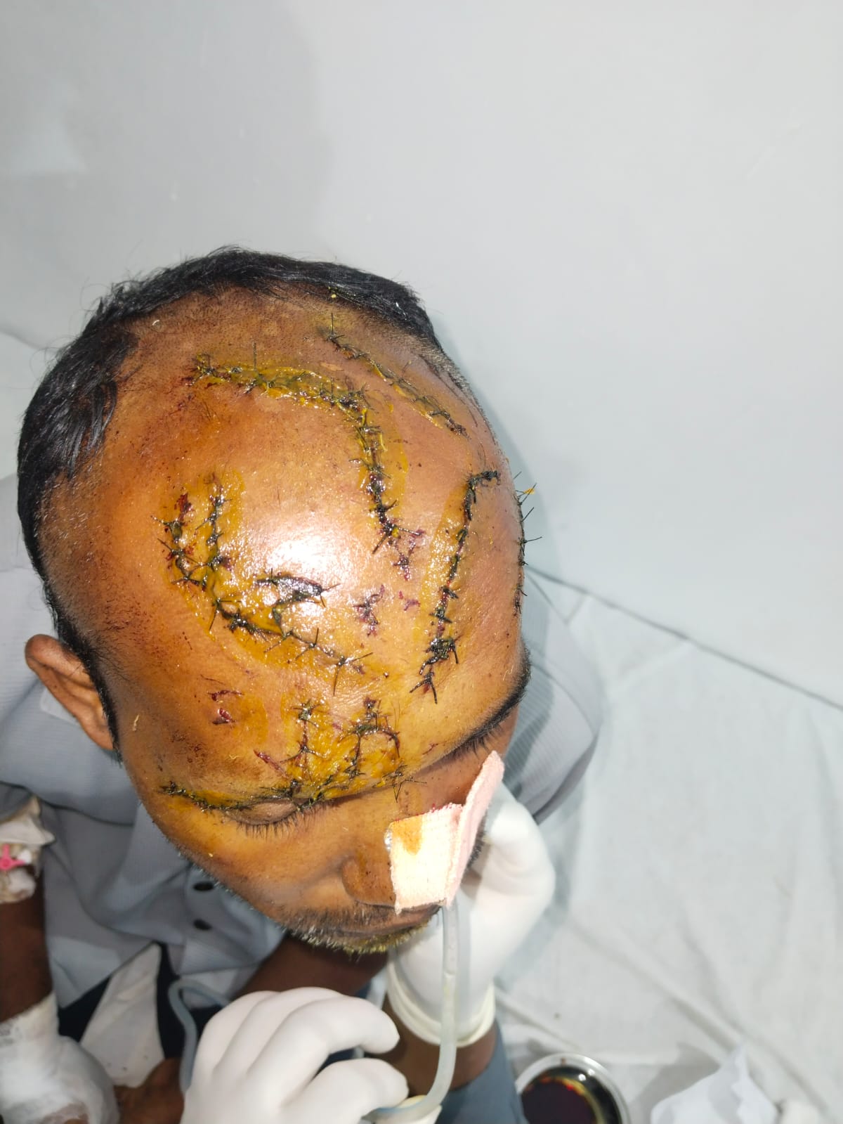 IMG-20260504-WA0007 भालू के हमले में गंभीर घायल युवक की 5 घंटे की सफल सर्जरी, मनेंद्रगढ़ 220 बिस्तर अस्पताल में बचाई गई जान।